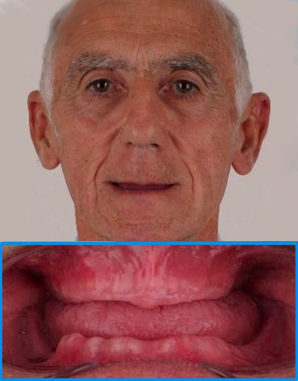 Before All-on-4 full arch dental implant restoration at Viet Bi Dental