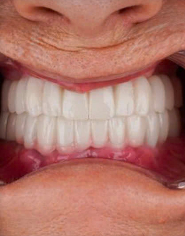 After implant-supported dental bridge — patient from Sydney Australia